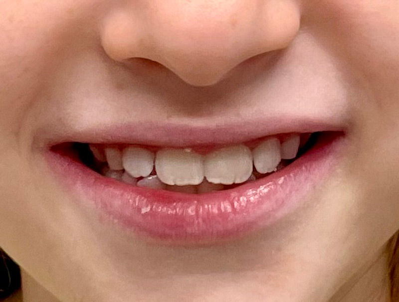Expander-and-braces-after