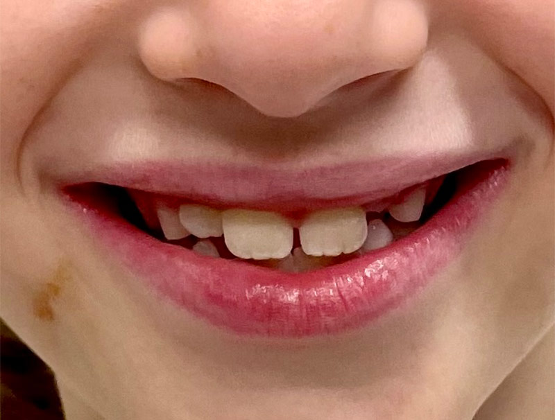 Expander-and-braces-before