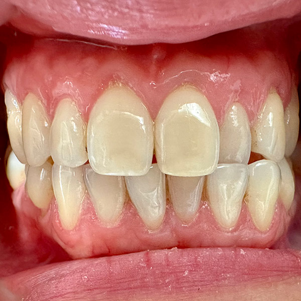 before teeth
