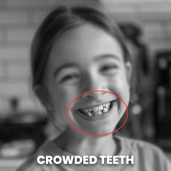 Crowded-Teeth Crowded Teeth