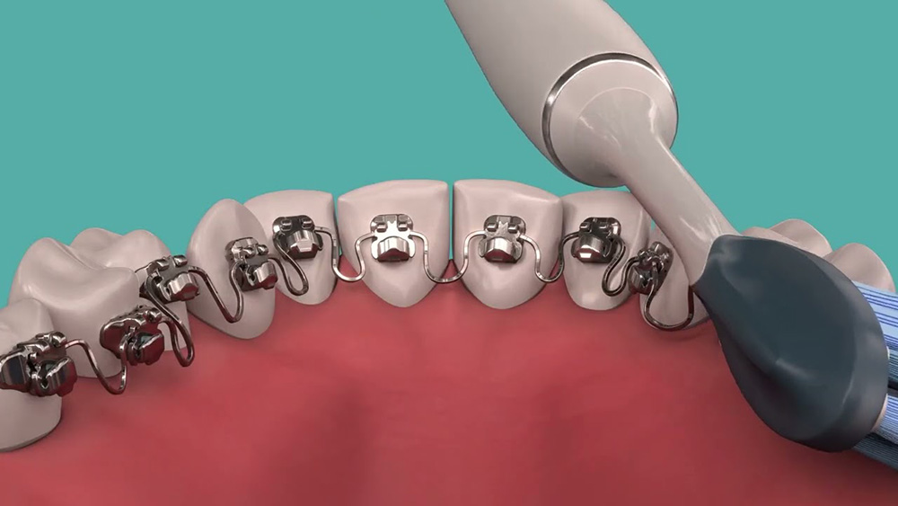 Discreet-Braces Discreet Braces