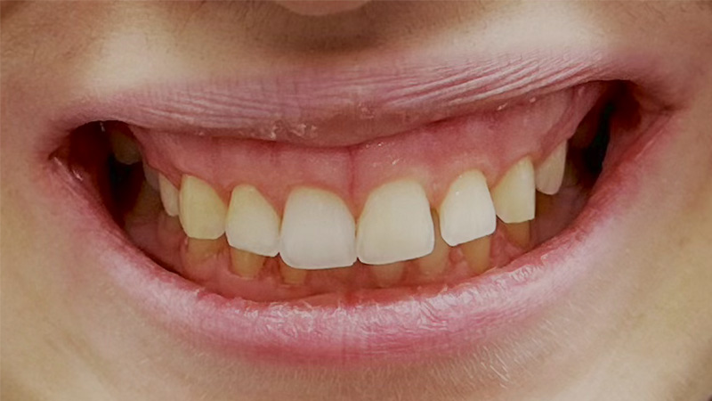 overbite correction nyc