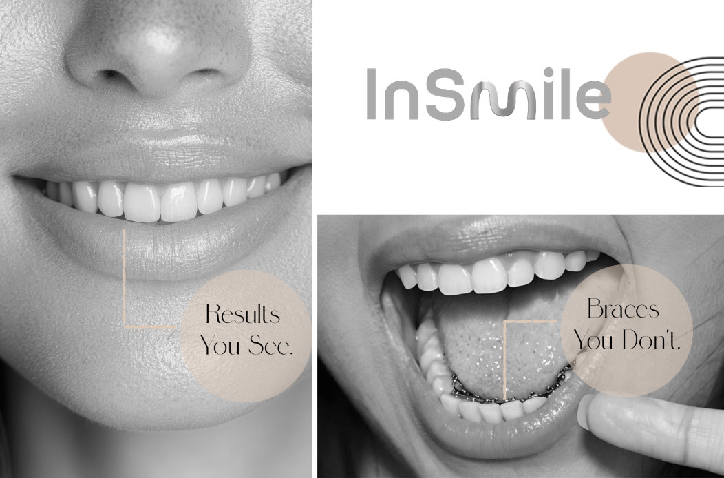 InSmile Braces NYC: Hidden Braces for Teens & Adults