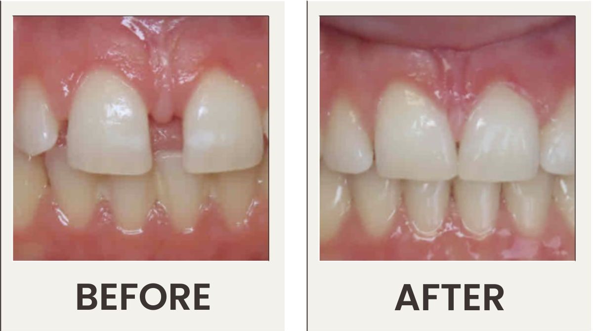 InSmile treatment results