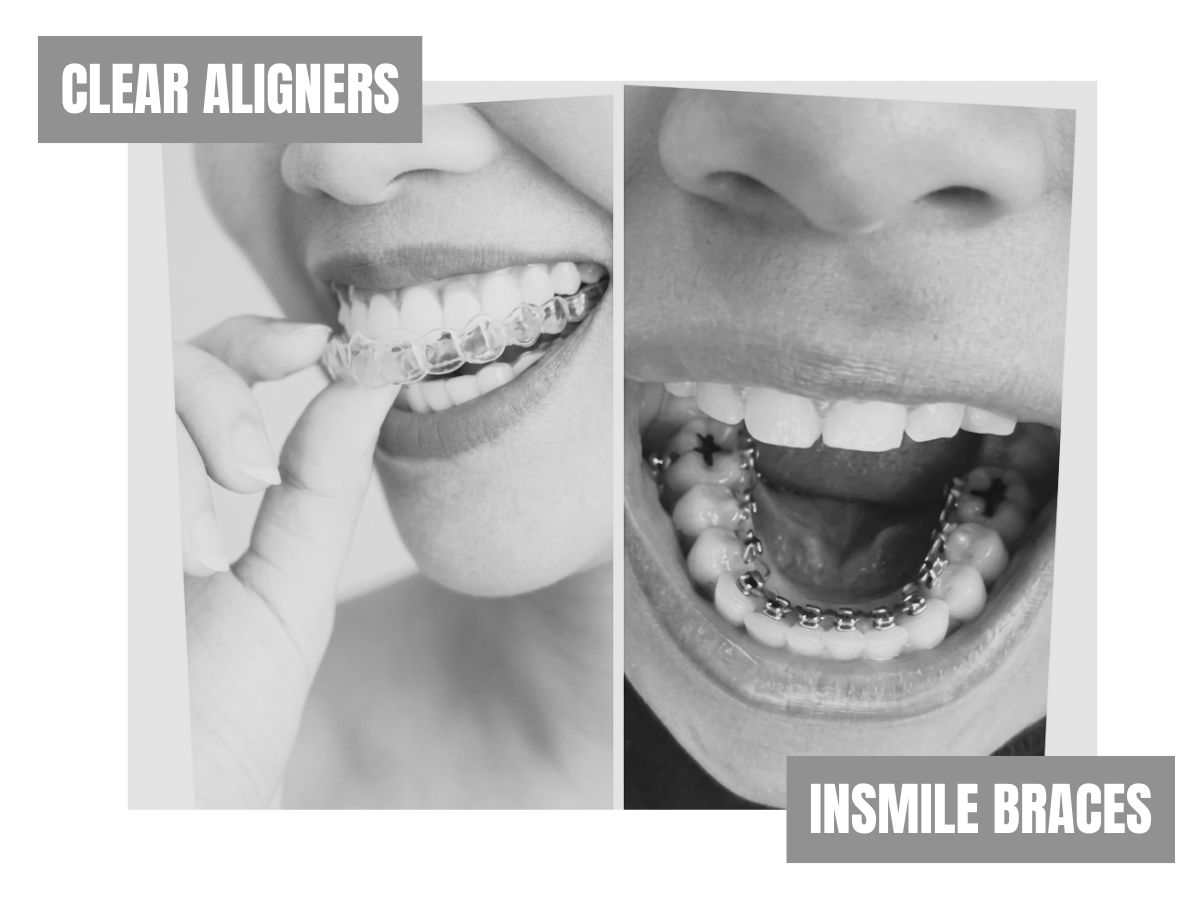 Behind-the-teeth InSmile braces