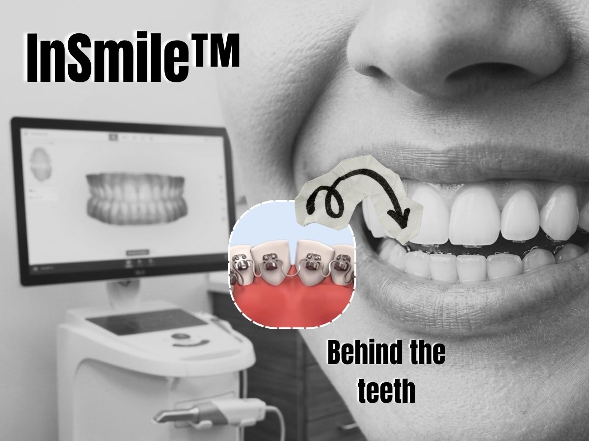 InSmile hidden braces behind the teeth