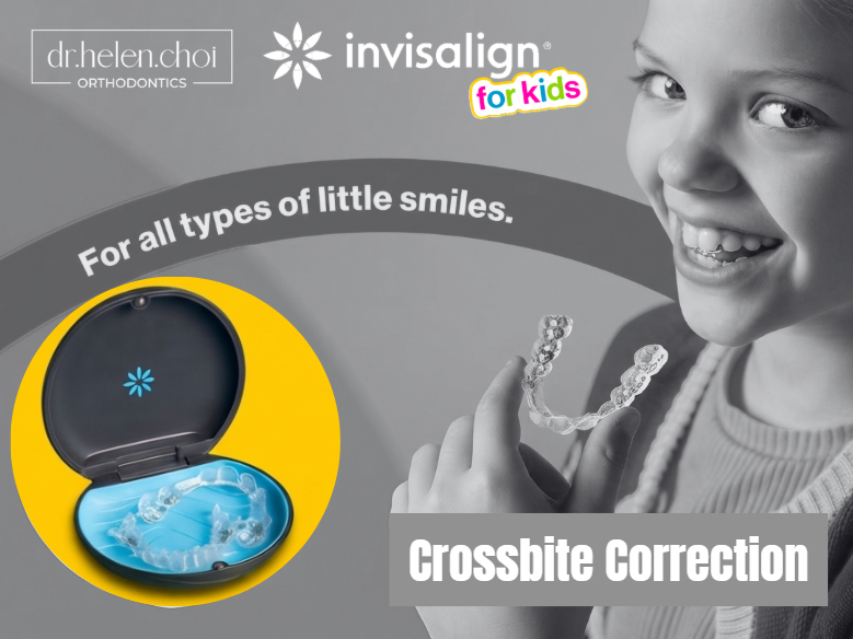 Single-Tooth Crossbite Correction with Invisalign for Kids in the Upper East Side